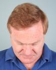 After Hair Transplant&nbsp;2 Sessions (Areas)